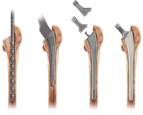 CORAIL Revision Stem