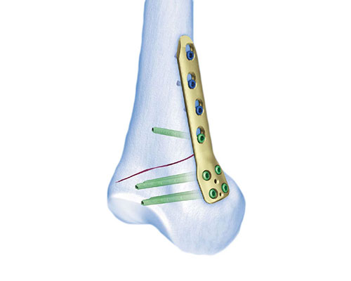 TomoFix Medial Distal Femur Plate