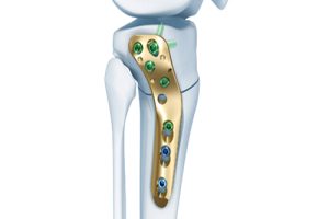 TomoFix Lateral High Tibia Plate