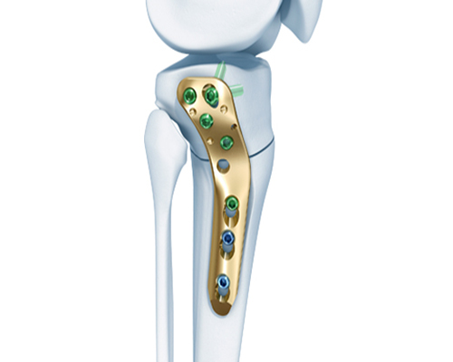 TomoFix Lateral High Tibia Plate